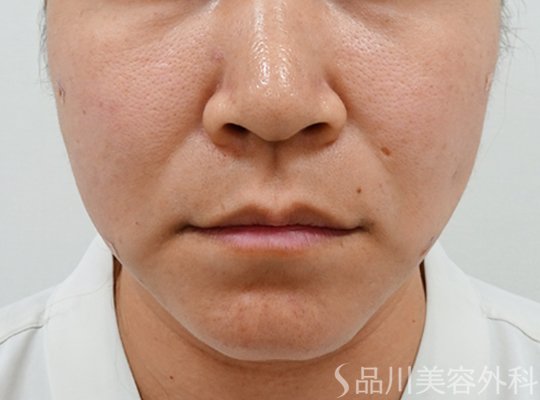 症例NO.72846のAFTER写真