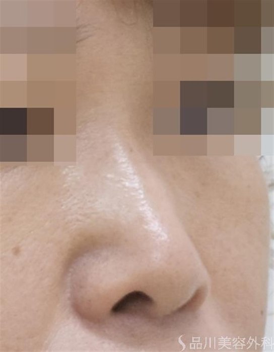 症例NO.50010のBEFORE写真