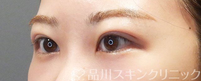 症例NO.75076のAFTER写真