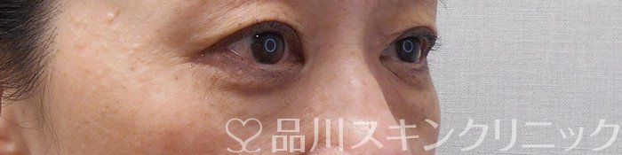 症例NO.70543のBEFORE写真