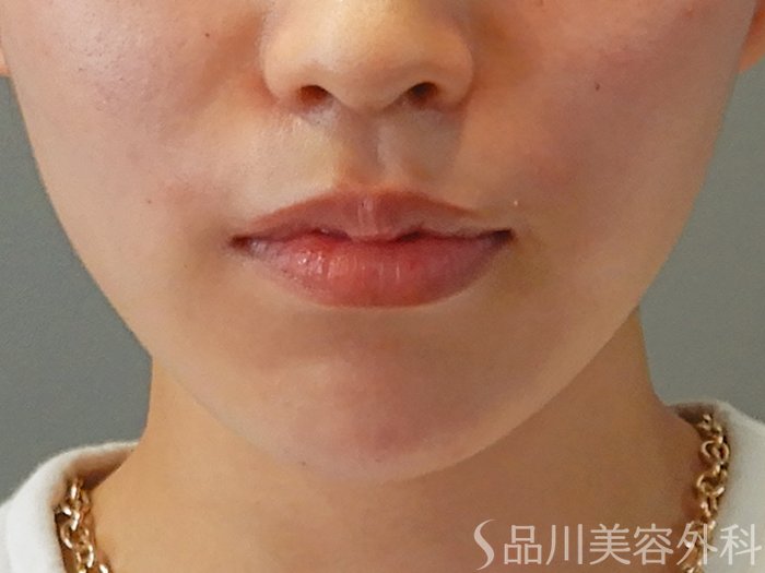 症例NO.70567のAFTER写真