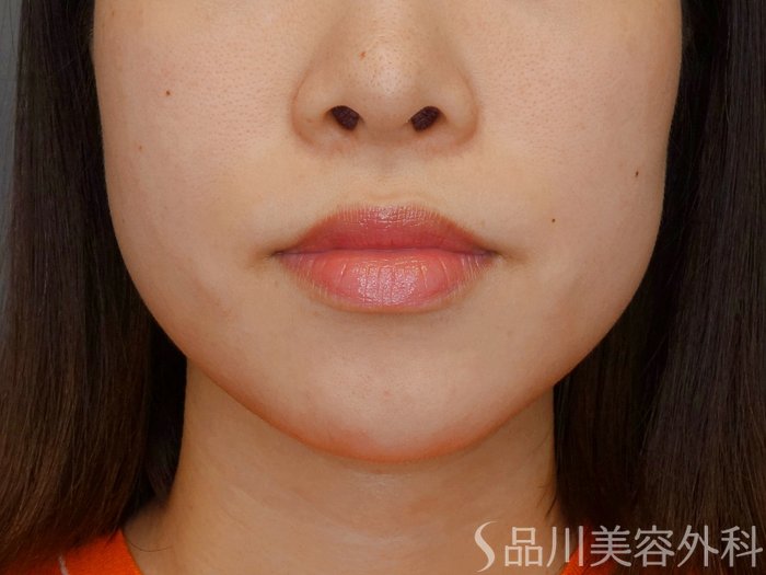 症例NO.70569のBEFORE写真