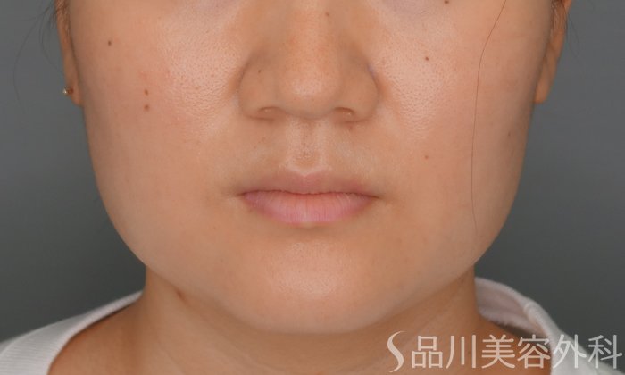 症例NO.70108のAFTER写真