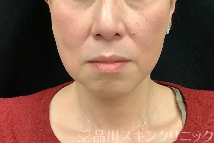 症例NO.71293のBEFORE写真