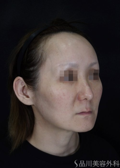 症例NO.70274のBEFORE写真