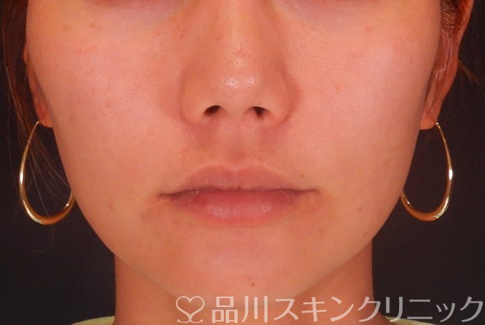 症例NO.65149のAFTER写真