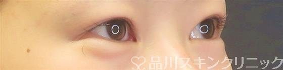 症例NO.59158のBEFORE写真