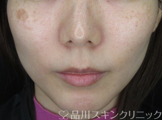 症例NO.70711のBEFORE写真