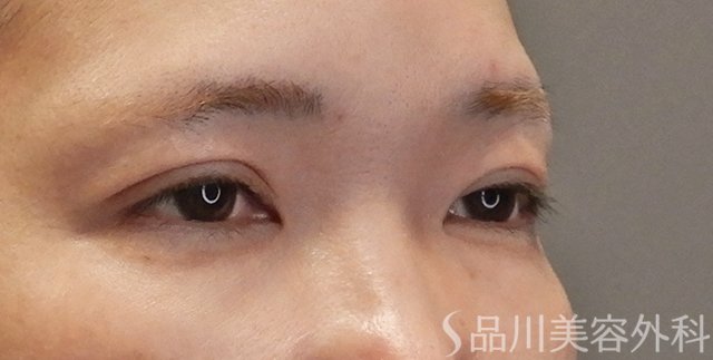 症例NO.75109のAFTER写真