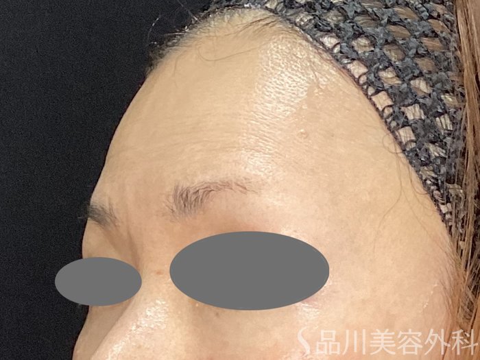 症例NO.72995のBEFORE写真