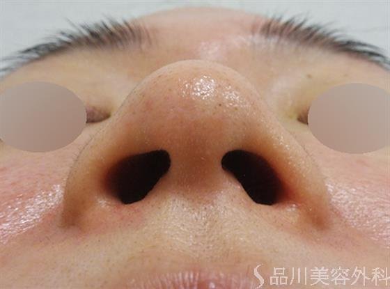 症例NO.51490のBEFORE写真