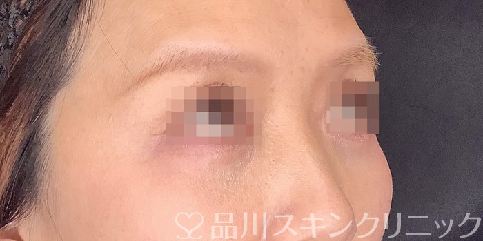 症例NO.71118のAFTER写真