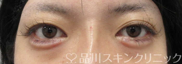 症例NO.74001のAFTER写真