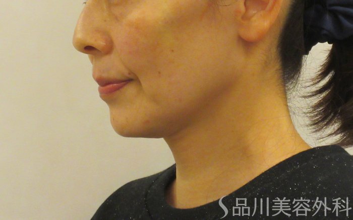 症例NO.72870のAFTER写真