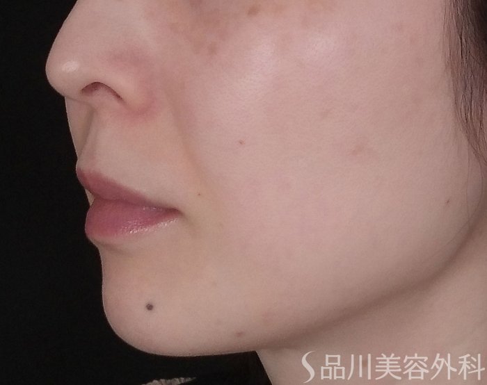 症例NO.69720のBEFORE写真
