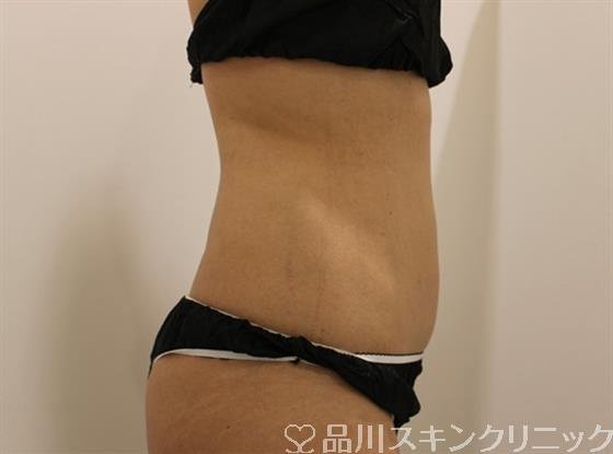 症例NO.45331のAFTER写真