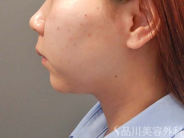 症例NO.74288のBEFORE写真