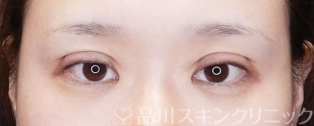 症例NO.75272のAFTER写真