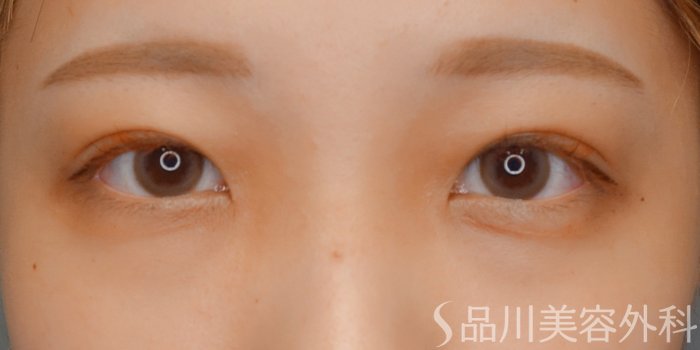 症例NO.73151のAFTER写真