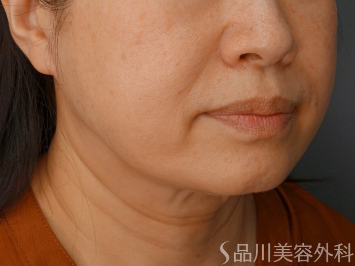 症例NO.70531のBEFORE写真