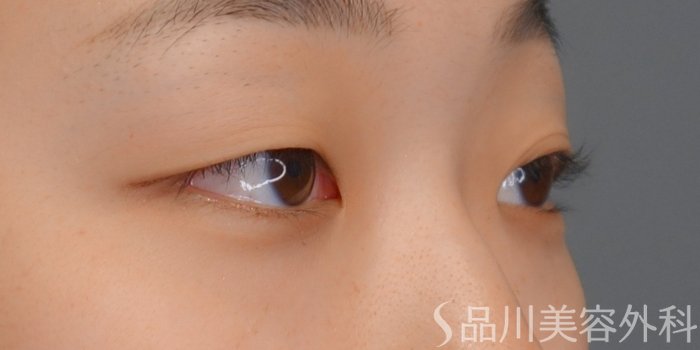 症例NO.74315のBEFORE写真