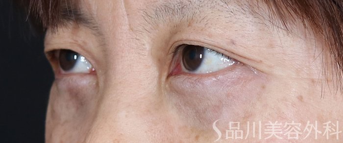 症例NO.71400のAFTER写真