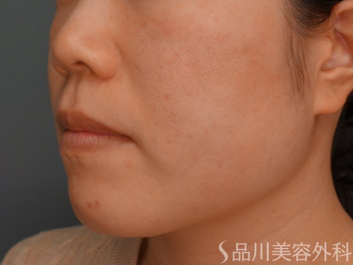 症例NO.75389のBEFORE写真