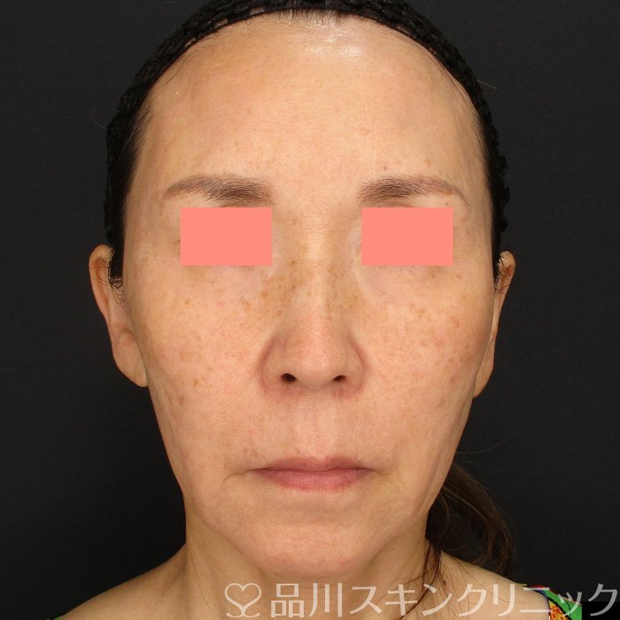 症例NO.71983のBEFORE写真