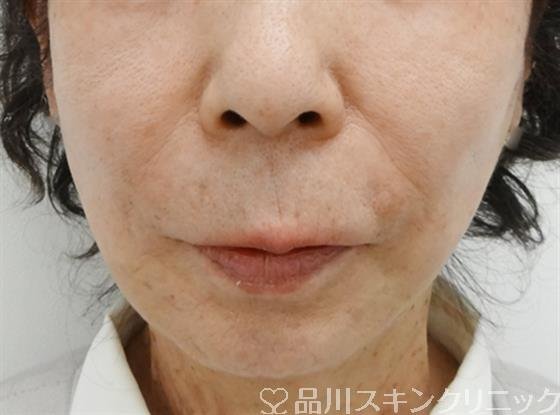 症例NO.40586のAFTER写真