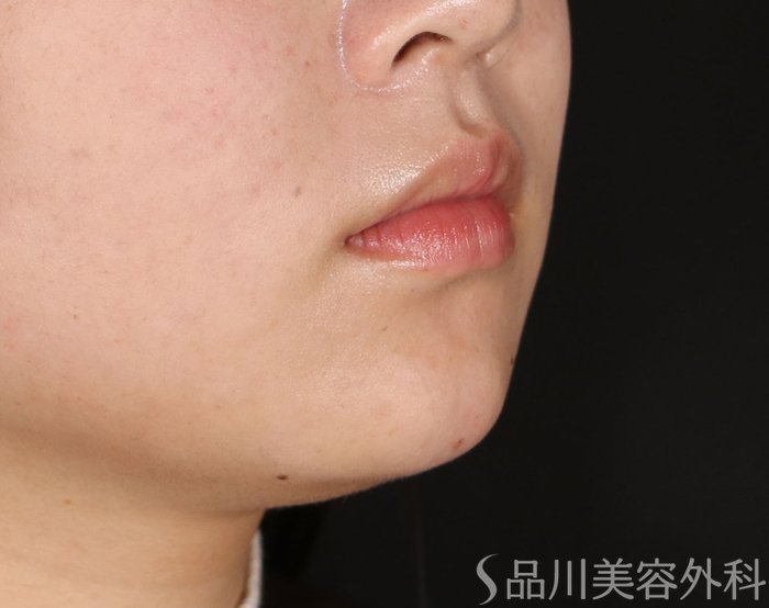 症例NO.72066のAFTER写真