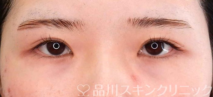 症例NO.62185のBEFORE写真