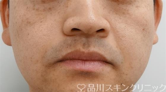 症例NO.29511のAFTER写真