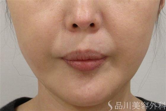症例NO.46313のAFTER写真