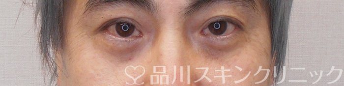 症例NO.70224のAFTER写真