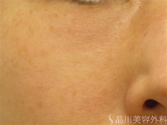 症例NO.51503のAFTER写真