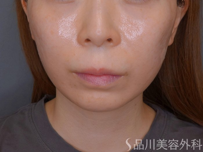 症例NO.74104のAFTER写真