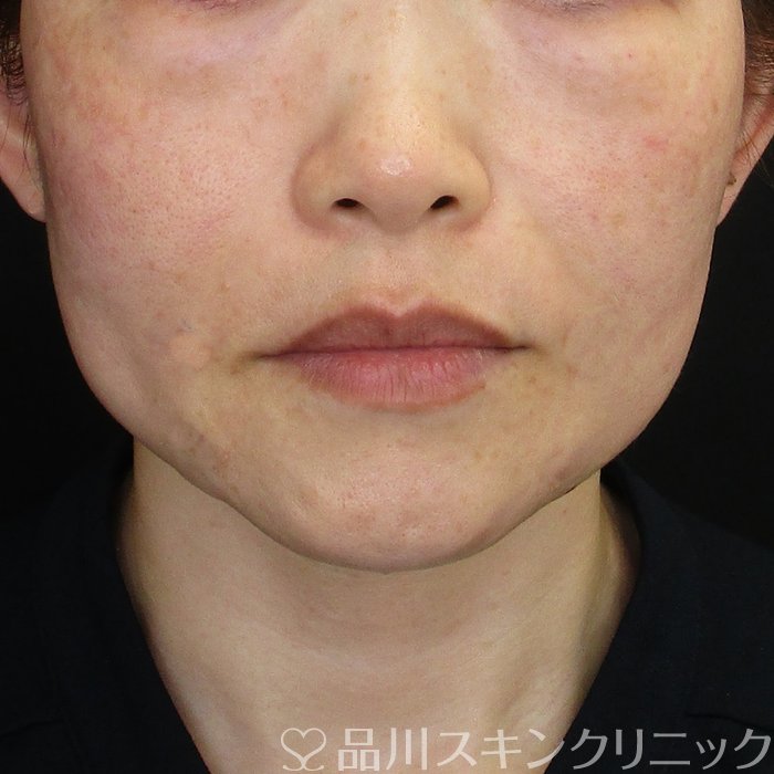 症例NO.73790のAFTER写真