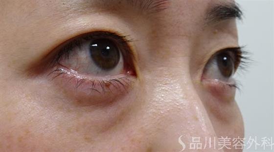 症例NO.54274のBEFORE写真