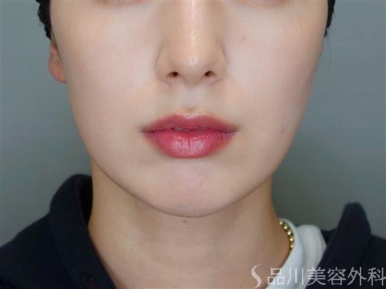 症例NO.50832のBEFORE写真