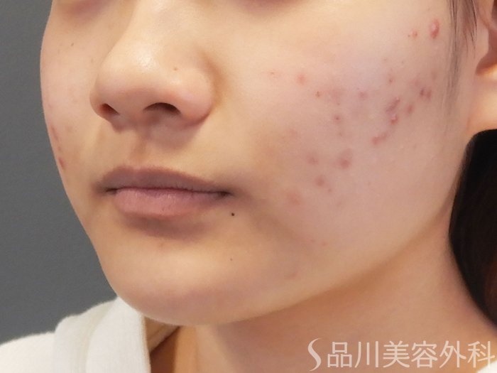 症例NO.72102のBEFORE写真