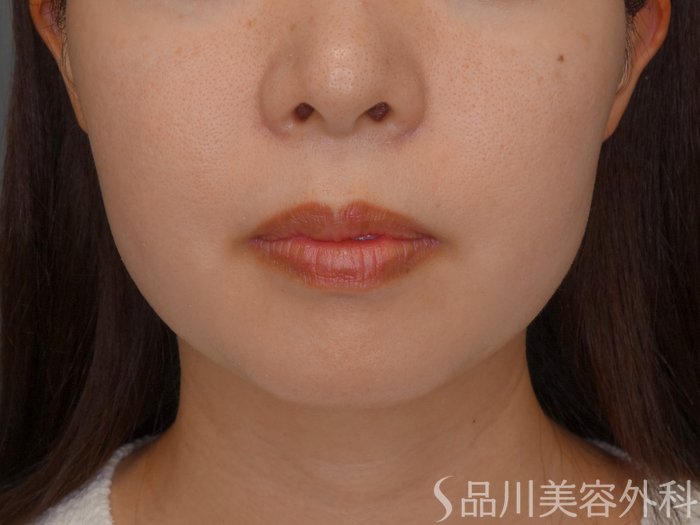 症例NO.71905のBEFORE写真