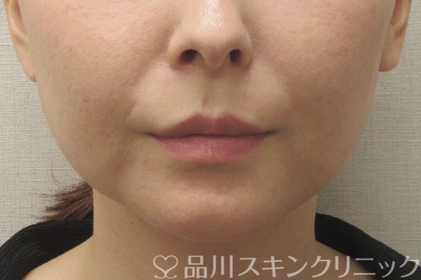 症例NO.72405のBEFORE写真