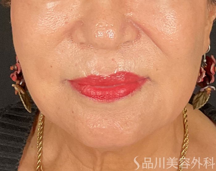 症例NO.74736のBEFORE写真