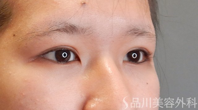 症例NO.75314のAFTER写真