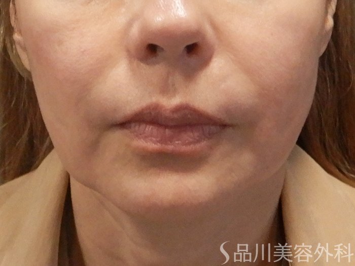 症例NO.71669のBEFORE写真