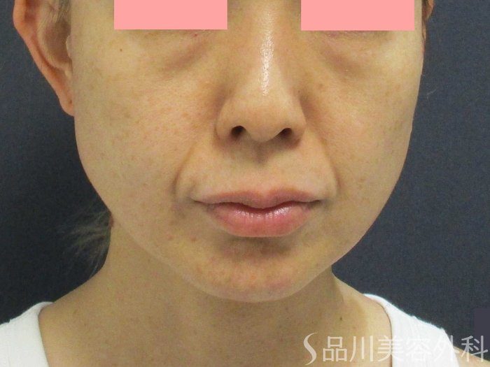 症例NO.69918のBEFORE写真
