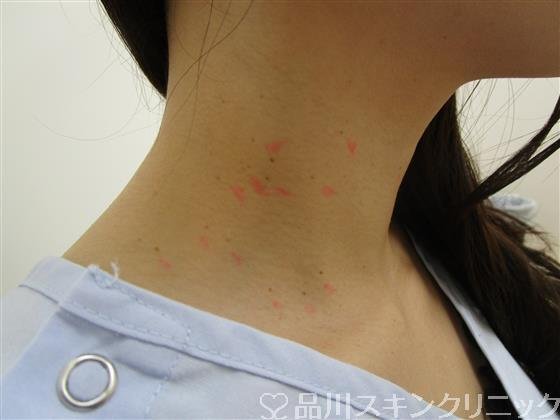 症例NO.39241のBEFORE写真