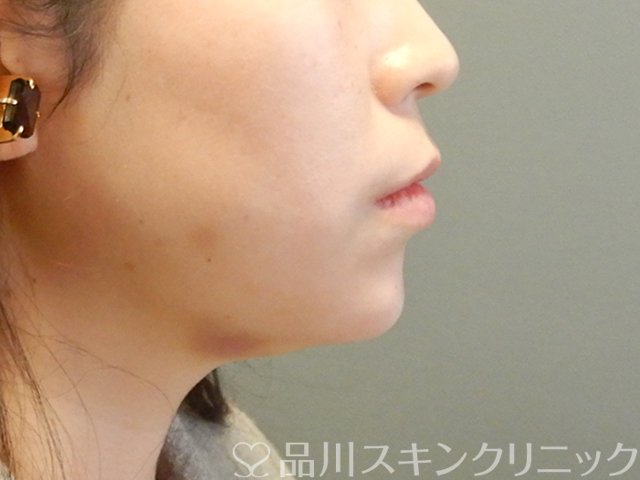 症例NO.63593のAFTER写真