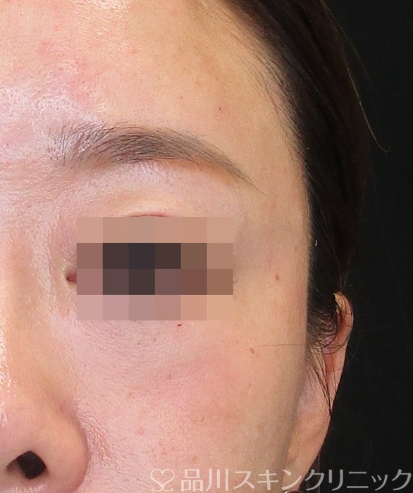 症例NO.73557のAFTER写真