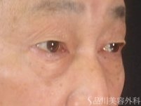 症例NO.74008のBEFORE写真